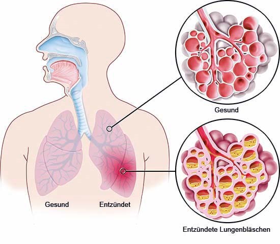 Grafik: Lungenentzündung im linken Lungenflügel