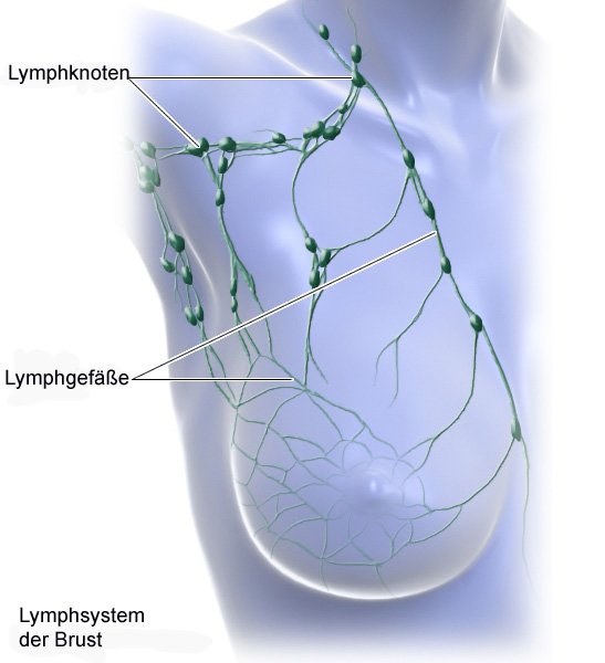 Aus brustkrebs wie sieht Brustkrebs (Mammakarzinom)