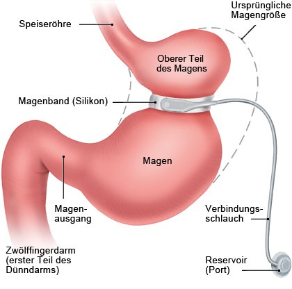 Grafik: Magenband