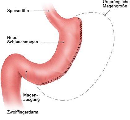 Grafik: Magenverkleinerung (Schlauchmagen-Operation)