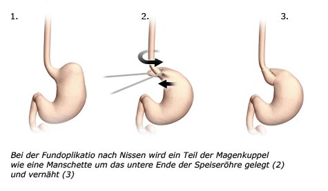 Grafik: Fundoplikatio nach Nissen: Ein Teil der Magenkuppel wird wie eine Manschette um das untere Ende der Speiseröhre gelegt