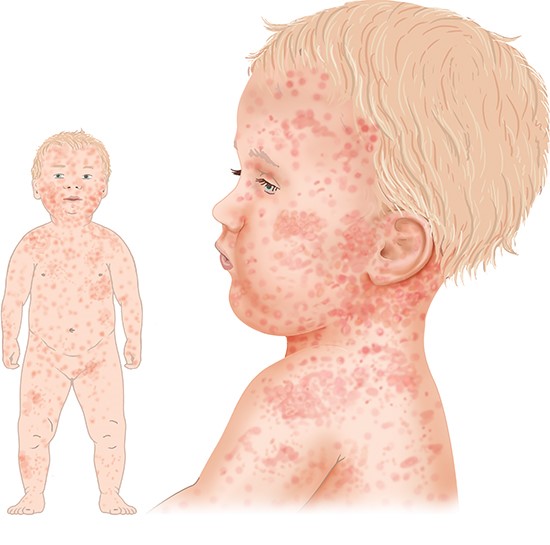 Grafik: Kind mit typischem Hautausschlag bei Masern