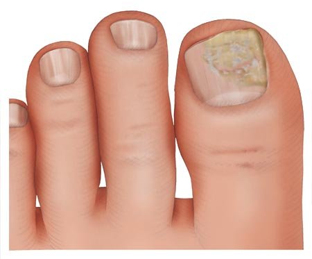 Fußnägel weiße Nagelerkrankungen: Es
