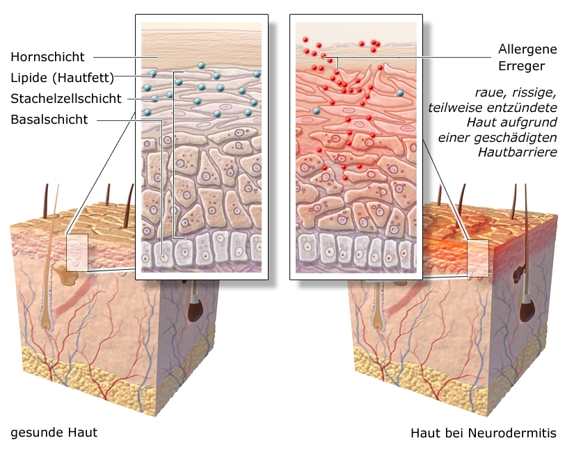 Экзема схема