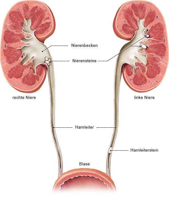 Grafik: Nieren und ableitende Harnwege mit Steinen in Niere und Harnleiter