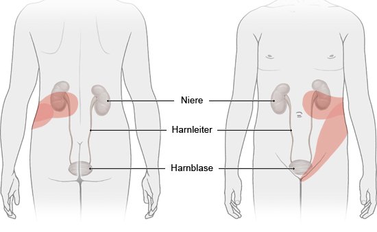 Grafik: Schmerzen bei linkseitigen Nierensteinen: Stellen, an denen sie typischerweise auftreten - wie im Text beschrieben