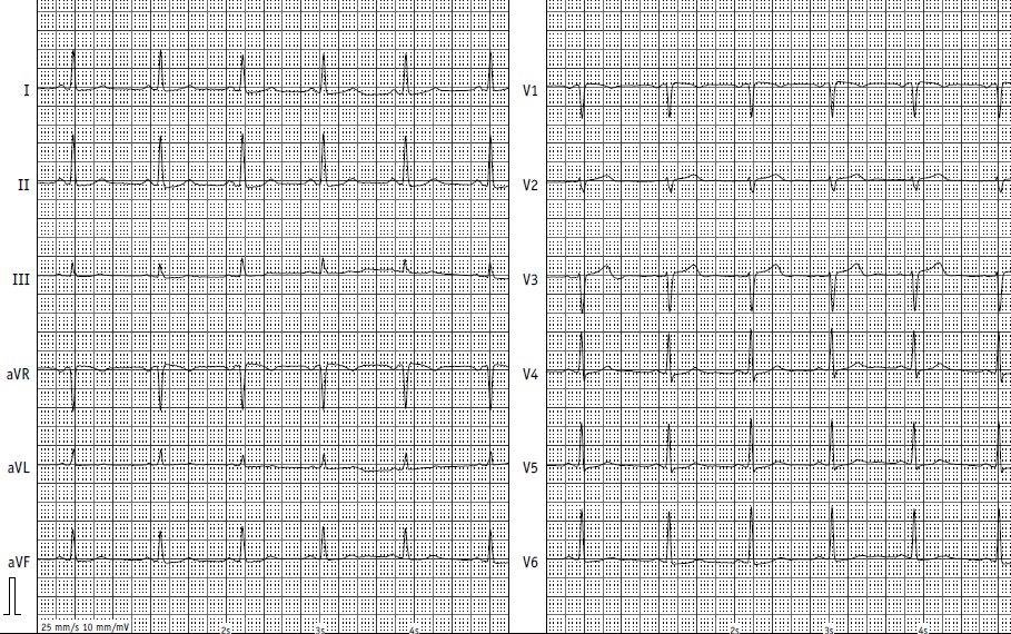 Grafik: Normales EKG – links die Ableitungen von Armen und Beinen, rechts die von der Brustwand. Quelle: CCB Frankfurt a.M.