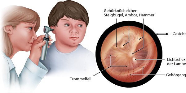 Grafik: Ohrspiegelung und Ansicht des Trommelfells - wie im Text beschrieben