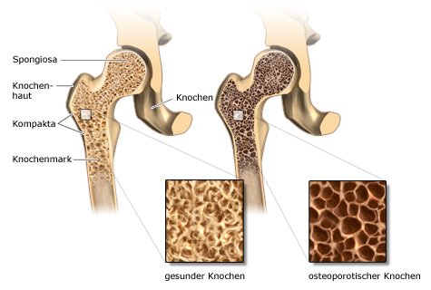 Grafik: links gesunder, rechts brüchiger Knochen bei starker Osteoporose - wie im Text beschrieben