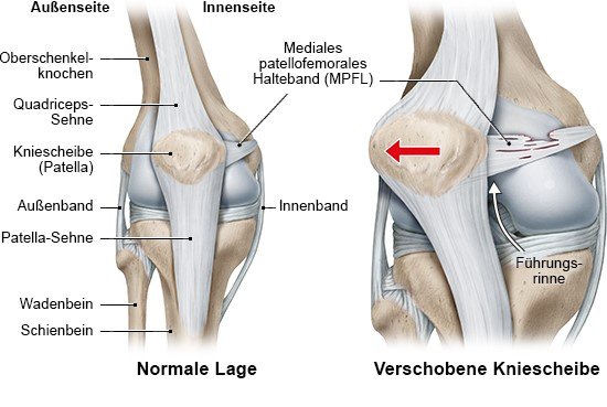 Grafik: normale Anatomie des Knies (links) und Patella-Luxation (rechts)