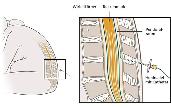 Die vereinfachte anatomische Grafik zeigt, wie und wo eine Periduralanästhesie (PDA) gesetzt wird (Detailansicht rechts).