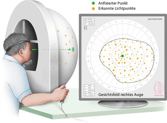 Grafik: Perimetrie-Untersuchung: Jeder erkannte Lichtpunkt wird mit einem Klick bestätigt