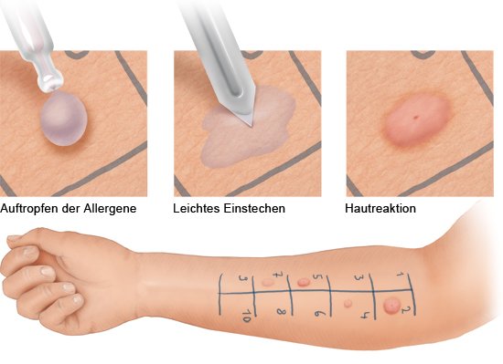 Grafil: Ablauf des Prick-Tests und Ergebnisse auf heller Haut - wie im Text beschrieben