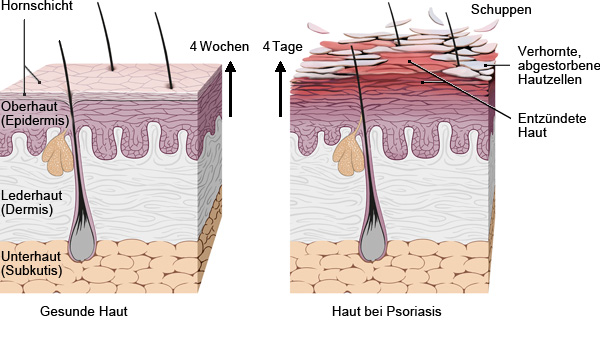 Grafik: Vermehrung und Abstoßung der Hautzellen - wie im Text beschrieben