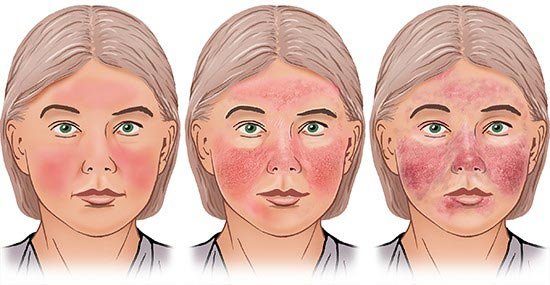 Haut nasenflügel trockene rote Krankheiten von