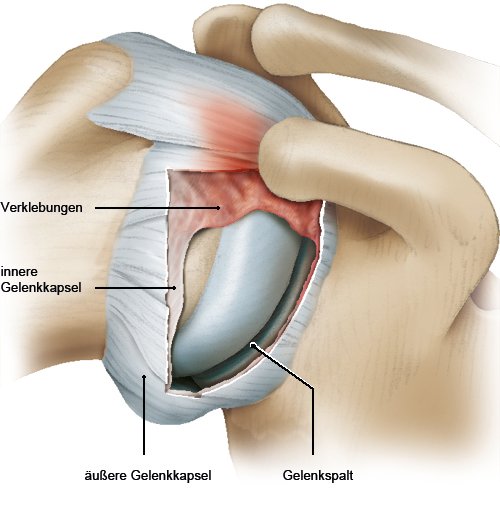 Grafik: Schultersteife: Narbenähnliche Verklebungen in der Gelenkkapsel - wie im Text beschrieben