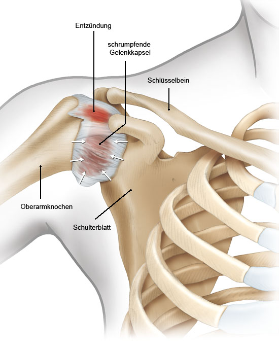Grafik: Schultergelenk (außen) mit Entzündung in der Gelenkkapsel - wie im Text beschrieben