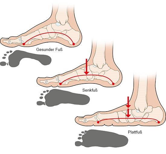 Grafik: Gesunder Fuß, Senk- und Plattfuß - wie im Text beschrieben.