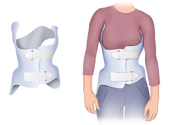 Grafik: Ein orthopädisches Korsett wird individuell angepasst