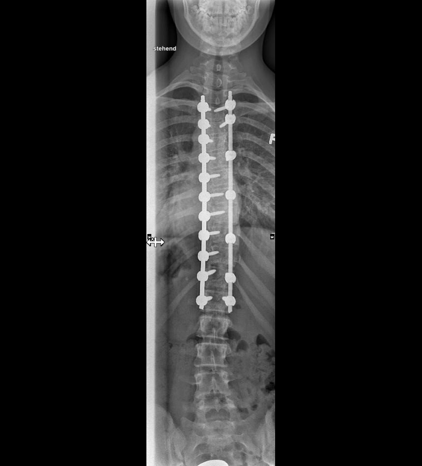 Grafik: Röntgenbild der Wirbelsäule nach einer Versteifungsoperation