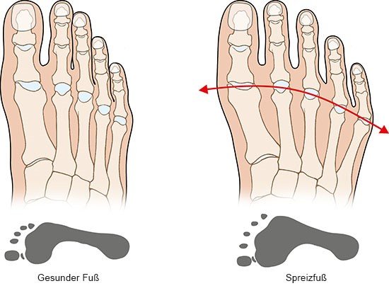 Grafik: Gesunder Fuß und Spreizfuß - wie im Text besprochen