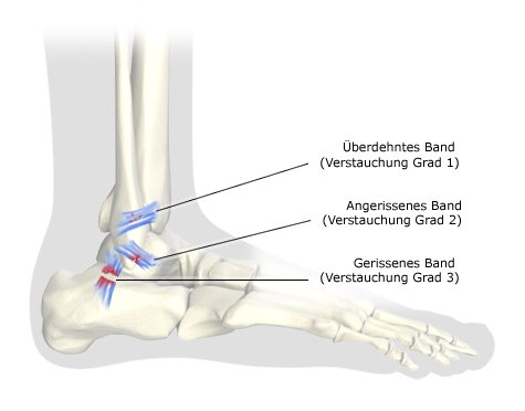 Grafik: Fußknochen (Ansicht von der Außenseite) mit Verstauchungen 1., 2. und 3. Grades - wie im Text beschrieben