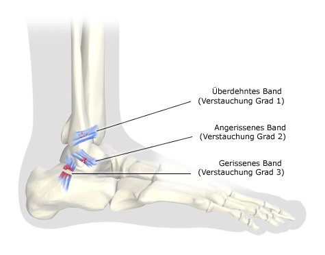 Knöchel schmerzen dicker keine Schmerzender u.