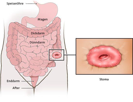 Die vereinfachte anatomische Grafik zeigt einen endständigen künstlichen Dickdarmausgang (Kolostoma) in situ (links) und in Detailansicht.
