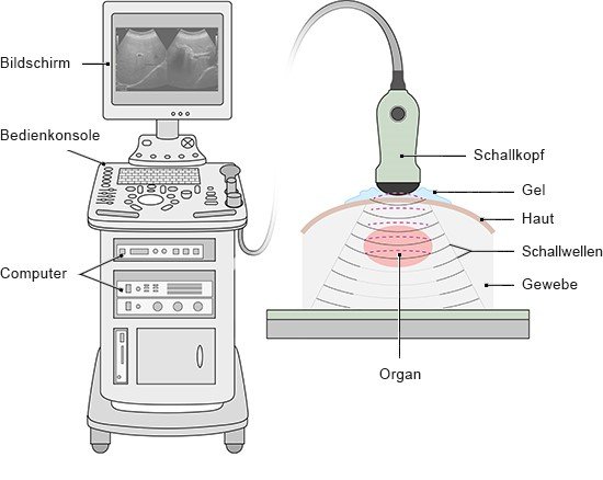 Grafik: Ultraschallgerät mit Bildschirm und Schallkopf - wie im Text beschrieben