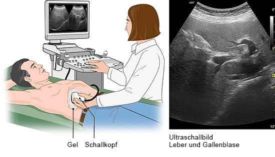 Die Grafik zeigt eine Ärztin und einen Patienten bei der Ultraschalluntersuchung des Bauches sowie das dazugehörige Ultraschallbild von Leber und Gallenblase. 