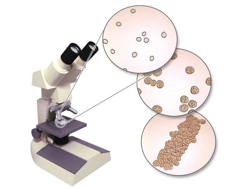 Grafik: Mikroskopische Untersuchung der festen Urinbestandteile