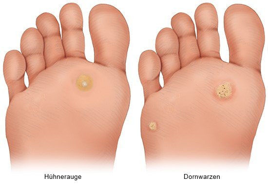 In kleine der fußsohle löcher Hautpilze richtig