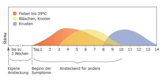 Windpocken: Verlauf und Ansteckungszeiten