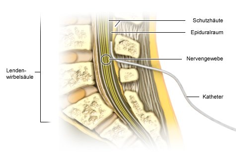 Grafik: Epiduralkatheter - wie im Text beschrieben