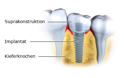 Grafik: Implantat mit aufgesetztem Zahnersatz - wie im Text beschrieben