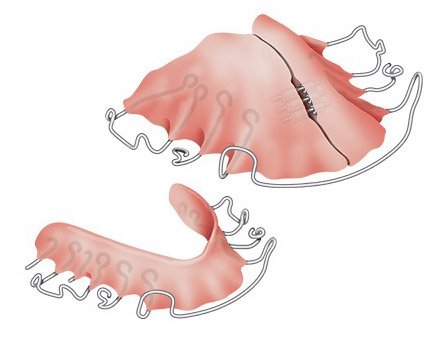 Grafik: Herausnehmbare Zahnspangen für den Ober- und Unterkiefer