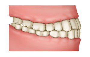Grafik: Beim normalen Gebiss greifen die Zähne leicht versetzt ineinander
