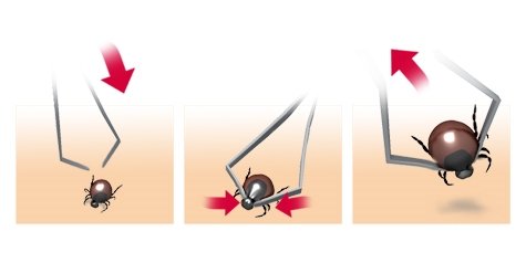 Grafik: Zecken-Entfernung mit Pinzette - wie im Text beschrieben