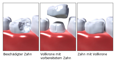 Zahnersatz Arten Und Kosten  . Arten Von Zahnimplantaten Was Krankenkassen Übernehmen Von Uns Erklärt.
