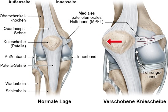 Prellung Knie Wie Lange Krank www.gesundheitsinformation.de
