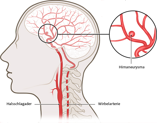 Wie Merkt Man Ein Aneurysma Im Kopf