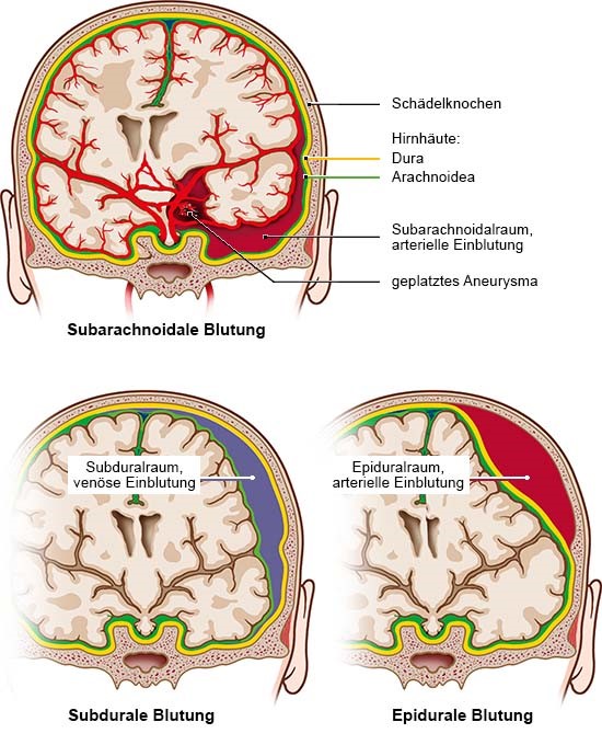 Epidural Subdural Subarachnoidal Blutung - maternity photos