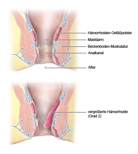 Wie sehen hämorrhoiden aus fotos