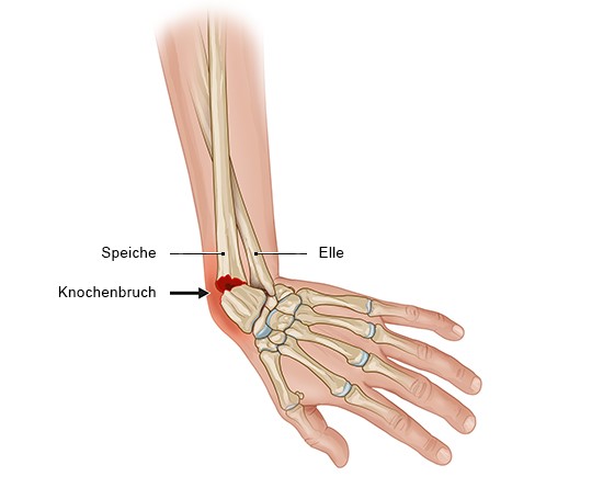 Handgelenksverletzungen - gesundheitsinformation.de